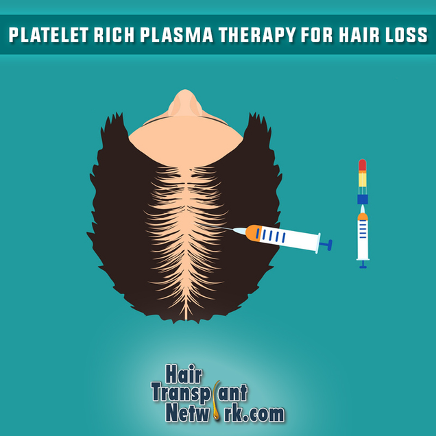 Illustration for article titled Platelet Rich Plasma Therapy For Hair Loss